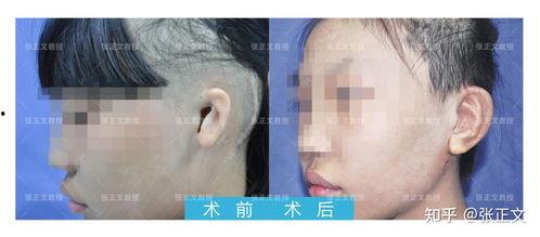 成人耳廓拼接再造视频,重塑美丽轮廓的神奇之旅