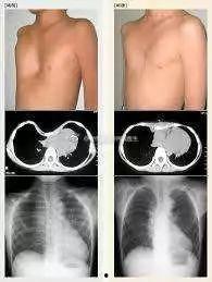 成人胸廓畸形视频讲解
